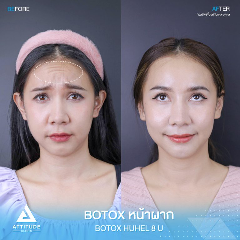 รีวิวฉีดโบท็อกซ์ลดริ้วรอย Upper Face 40 ยูนิต ด้วย Botox Hugelโบท็อกซ์