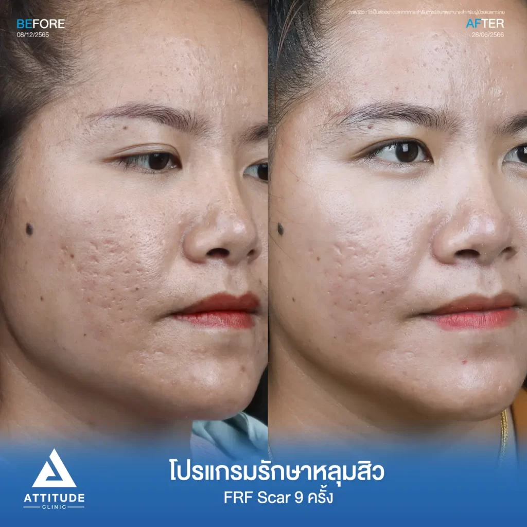 รีวิวรักษาหลุมสิวคุณกนกวรรณ FRF Scar จำนวน 9 ครั้ง รักษาหลุมสิว กระชับรูขุมขนทั่วใบหน้า โดยเฉพาะบริเวณหน้าแก้ม 2 ข้าง และหน้าผากที่ Attitude Clinic