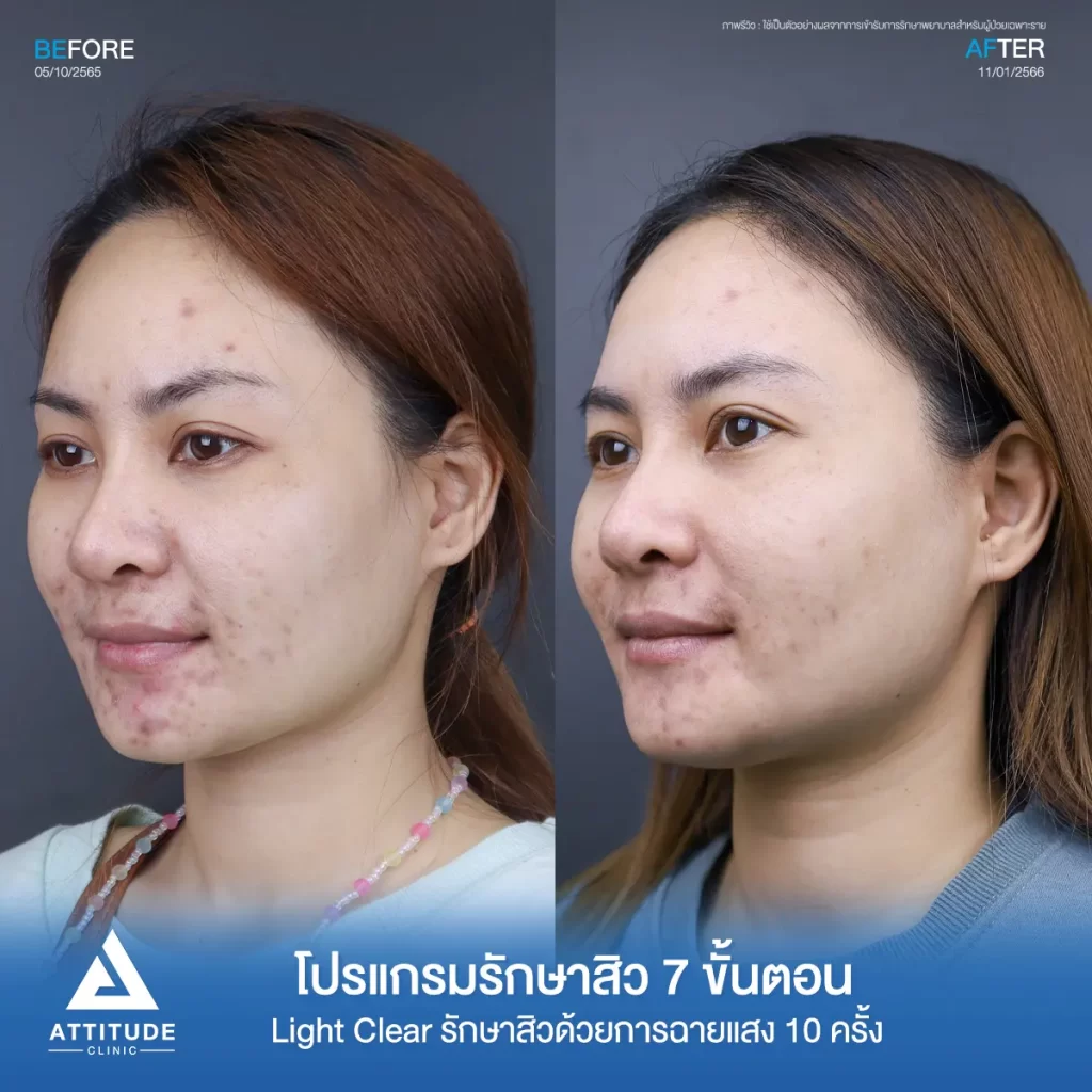 รีวิวรักษาสิวคุณหนึ่ง ด้วยการฉายแสง Light Clear 7 ขั้นตอน จำนวน 10 ครั้ง รักษาสิวอักเสบ สิวอุดตัน รอยแดงที่ขึ้นเยอะบริเวณรอบริมฝีปาก และคางที่ Attitude Clinic