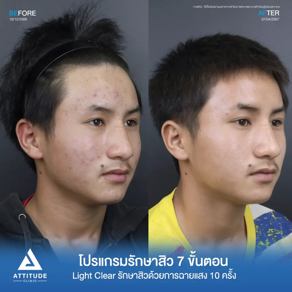 รีวิวรักษาสิวคุณอนุชา ด้วยการฉายแสง โปรแกรมรักษาสิว Light Clear 7 ขั้นตอน จำนวน 10 ครั้ง รักษาสิวอุดตัน สิวผด สิวอักเสบเม็ดเล็กๆ ทั่วใบหน้าที่ Attitude Clinic