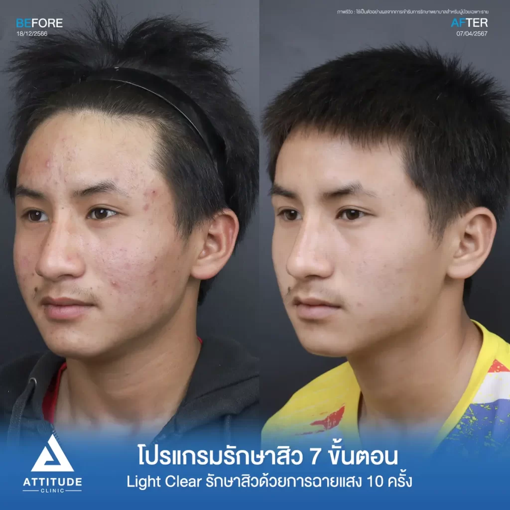 รีวิวรักษาสิวคุณอนุชา ด้วยการฉายแสง โปรแกรมรักษาสิว Light Clear 7 ขั้นตอน จำนวน 10 ครั้ง รักษาสิวอุดตัน สิวผด สิวอักเสบเม็ดเล็กๆ ทั่วใบหน้าที่ Attitude Clinic