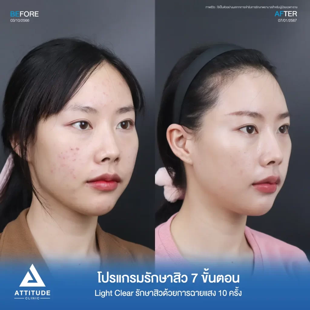 รีวิวรักษาสิวคุณฟลุ๊ค ด้วยการฉายแสง Light Clear 7 ขั้นตอน จำนวน 10 ครั้ง รักษาสิวอุดตัน สิวอักเสบ รอยแดงจากสิวทั่วใบหน้าที่ Attitude Clinic