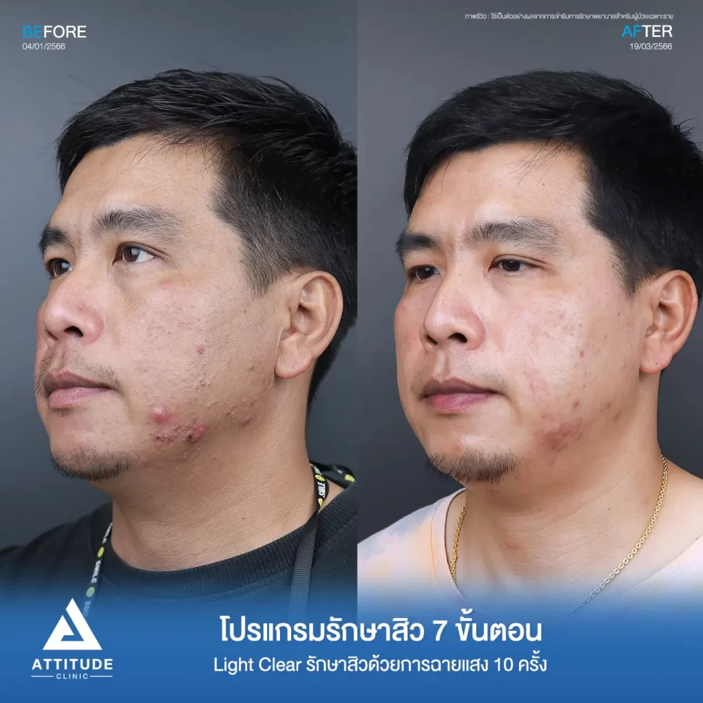 รีวิวรักษาสิวคุณรัชวุฒิ ด้วยการฉายแสง Light Clear 7 ขั้นตอน จำนวน 10 ครั้ง รักษาสิวอักเสบบริเวณกรอบหน้า รักษาสิวอุดตัน สิวผดเม็ดเล็กๆ ทั่วใบหน้าที่ Attitude Clinic