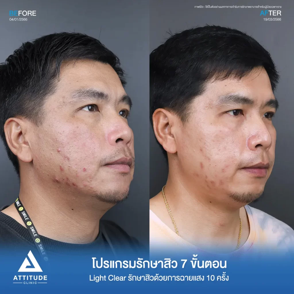 รีวิวรักษาสิวคุณรัชวุฒิ ด้วยการฉายแสง Light Clear 7 ขั้นตอน จำนวน 10 ครั้ง รักษาสิวอักเสบบริเวณกรอบหน้า รักษาสิวอุดตัน สิวผดเม็ดเล็กๆ ทั่วใบหน้าที่ Attitude Clinic