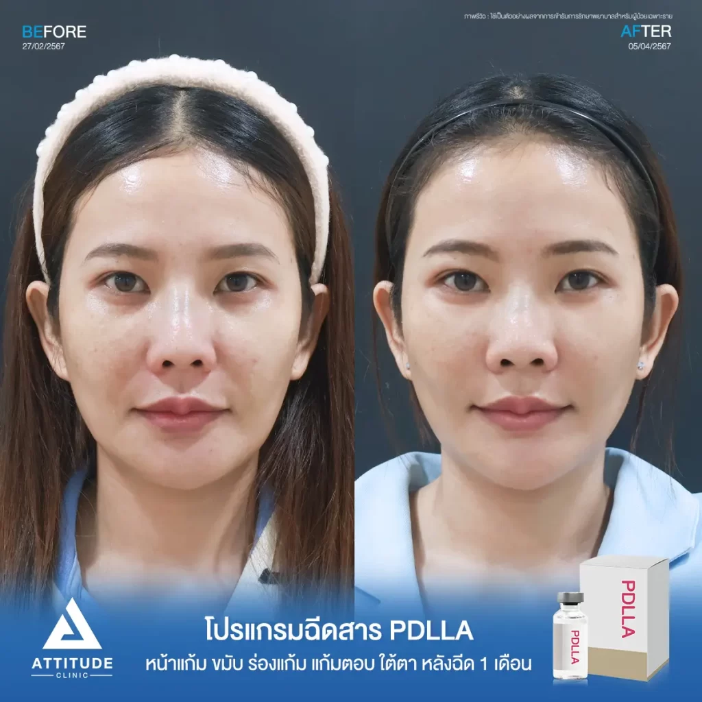 รีวิวโปรแกรมฉีดสาร PDLLA หลังฉีด 1 เดือนของคุณแอ๋ว เติมเต็มร่องลึก ปรับรูปหน้าให้อิ่มฟู ฟื้นฟูผิวเสื่อมโทรมบริเวณใต้ตา หน้าแก้ม ร่องแก้ม แก้มตอบ และขมับ ดูแลโดยคุณหมอทุกเคสที่ Attitude Clinic