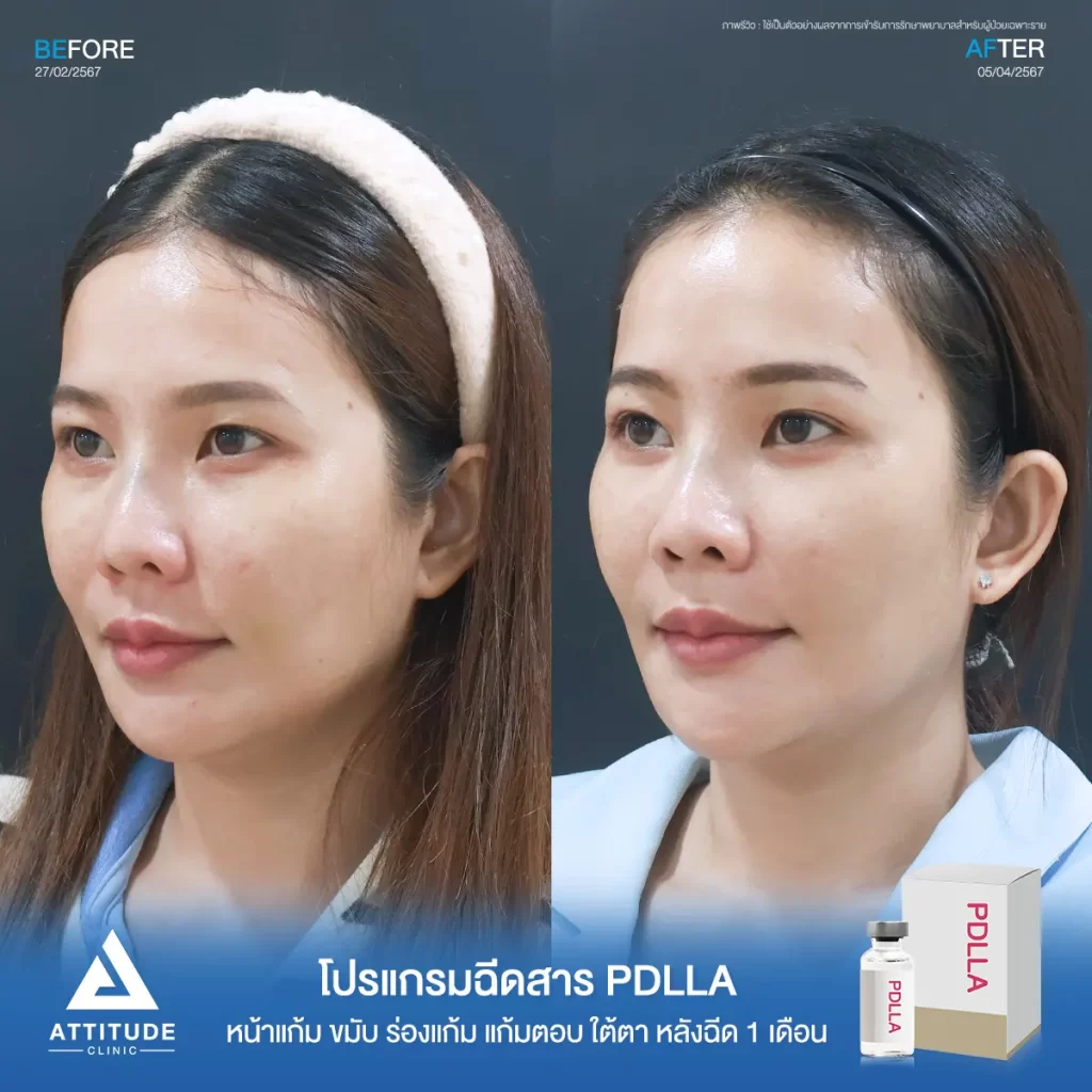 รีวิวโปรแกรมฉีดสาร PDLLA หลังฉีด 1 เดือนของคุณแอ๋ว เติมเต็มร่องลึก ปรับรูปหน้าให้อิ่มฟู ฟื้นฟูผิวเสื่อมโทรมบริเวณใต้ตา หน้าแก้ม ร่องแก้ม แก้มตอบ และขมับ ดูแลโดยคุณหมอทุกเคสที่ Attitude Clinic