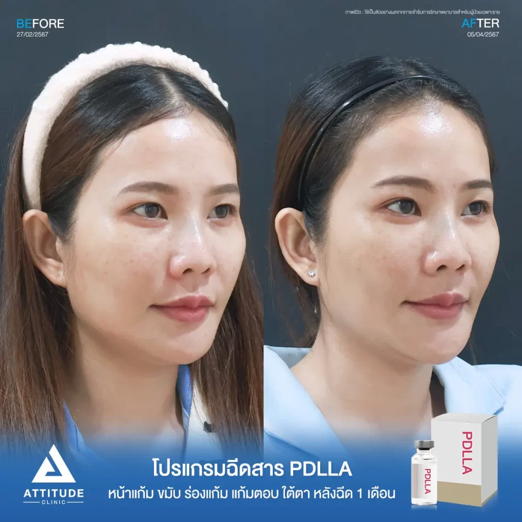 รีวิวโปรแกรมฉีดสาร PDLLA หลังฉีด 1 เดือนของคุณแอ๋ว เติมเต็มร่องลึก ปรับรูปหน้าให้อิ่มฟู ฟื้นฟูผิวเสื่อมโทรมบริเวณใต้ตา หน้าแก้ม ร่องแก้ม แก้มตอบ และขมับ ดูแลโดยคุณหมอทุกเคสที่ Attitude Clinic