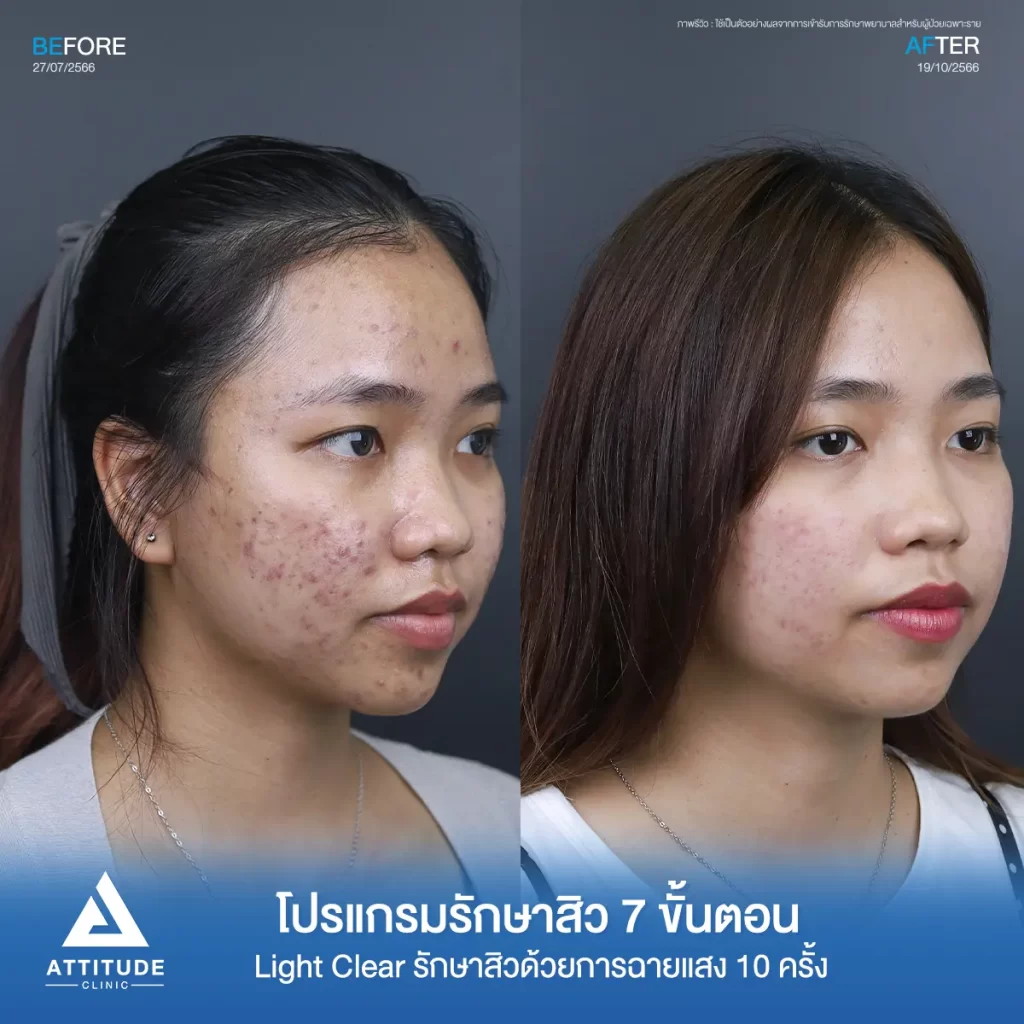 รีวิวรักษาสิวคุณระพีพร ด้วยการฉายแสง Light Clear 7 ขั้นตอน จำนวน 10 ครั้ง รักษาสิวอักเสบ สิวอุดตัน รอยแดงสิวทั่วใบหน้า กรอบหน้า และไรผมที่ Attitude Clinic