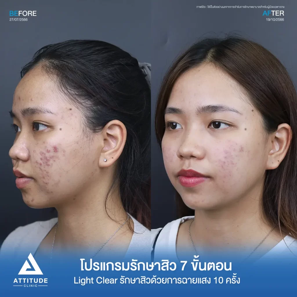 รีวิวรักษาสิวคุณระพีพร ด้วยการฉายแสง Light Clear 7 ขั้นตอน จำนวน 10 ครั้ง รักษาสิวอักเสบ สิวอุดตัน รอยแดงสิวทั่วใบหน้า กรอบหน้า และไรผมที่ Attitude Clinic