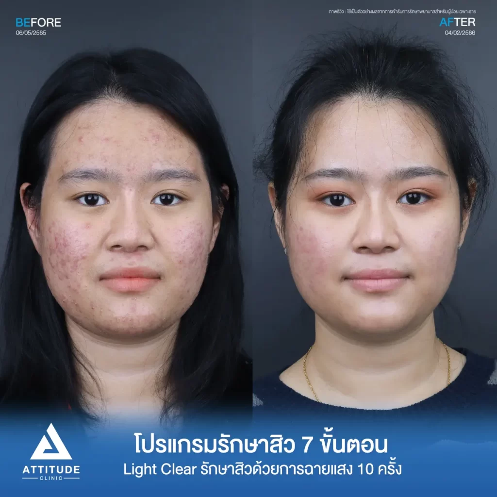 รีวิวรักษาสิวคุณธนาภา ด้วยการฉายแสง Light Clear 7 ขั้นตอน จำนวน 10 ครั้ง รักษาสิวอักเสบมีหนอง สิวอุดตัน รอยแดงสิวทั่วใบหน้าที่ Attitude Clinic