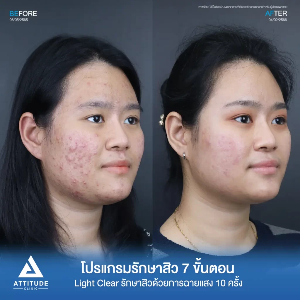 รีวิวรักษาสิวคุณธนาภา ด้วยการฉายแสง Light Clear 7 ขั้นตอน จำนวน 10 ครั้ง รักษาสิวอักเสบมีหนอง สิวอุดตัน รอยแดงสิวทั่วใบหน้าที่ Attitude Clinic