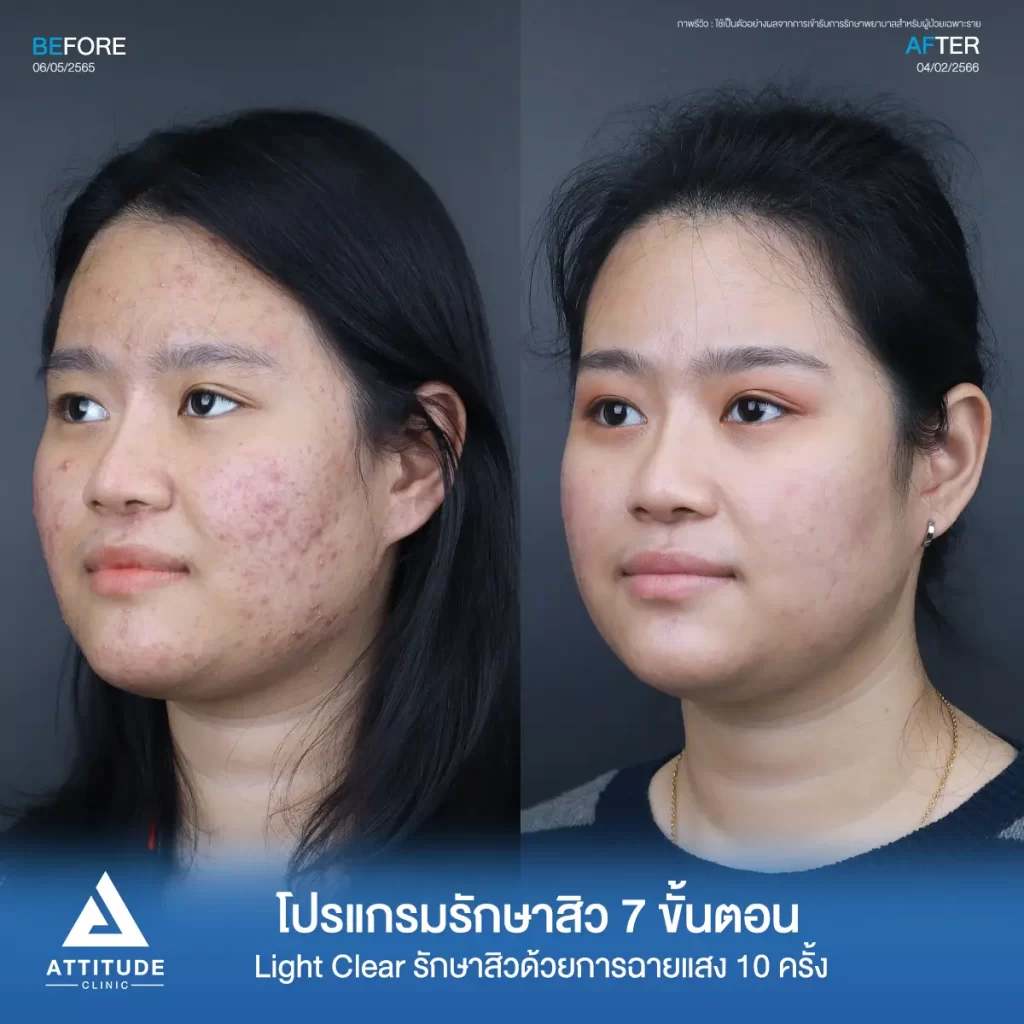 รีวิวรักษาสิวคุณธนาภา ด้วยการฉายแสง Light Clear 7 ขั้นตอน จำนวน 10 ครั้ง รักษาสิวอักเสบมีหนอง สิวอุดตัน รอยแดงสิวทั่วใบหน้าที่ Attitude Clinic