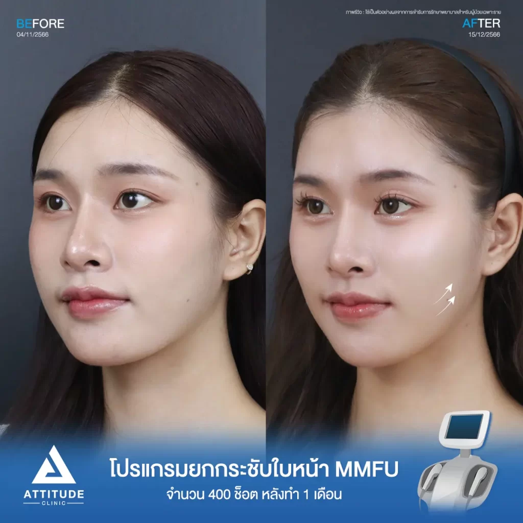 รีวิวโปรแกรมยกกระชับใบหน้า MMFU จำนวน 400 ช็อต หลังทำ 1 เดือนของน้องนาย ยกกระชับผิวบริเวณข้างแก้ม หน้าแก้ม เห็นกรอบหน้าชัดขึ้น หน้าเรียวสวยขึ้นที่ Attitude Clinic