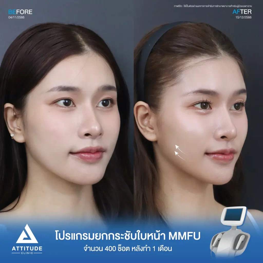 รีวิวโปรแกรมยกกระชับใบหน้า MMFU จำนวน 400 ช็อต หลังทำ 1 เดือนของน้องนาย ยกกระชับผิวบริเวณข้างแก้ม หน้าแก้ม เห็นกรอบหน้าชัดขึ้น หน้าเรียวสวยขึ้นที่ Attitude Clinic