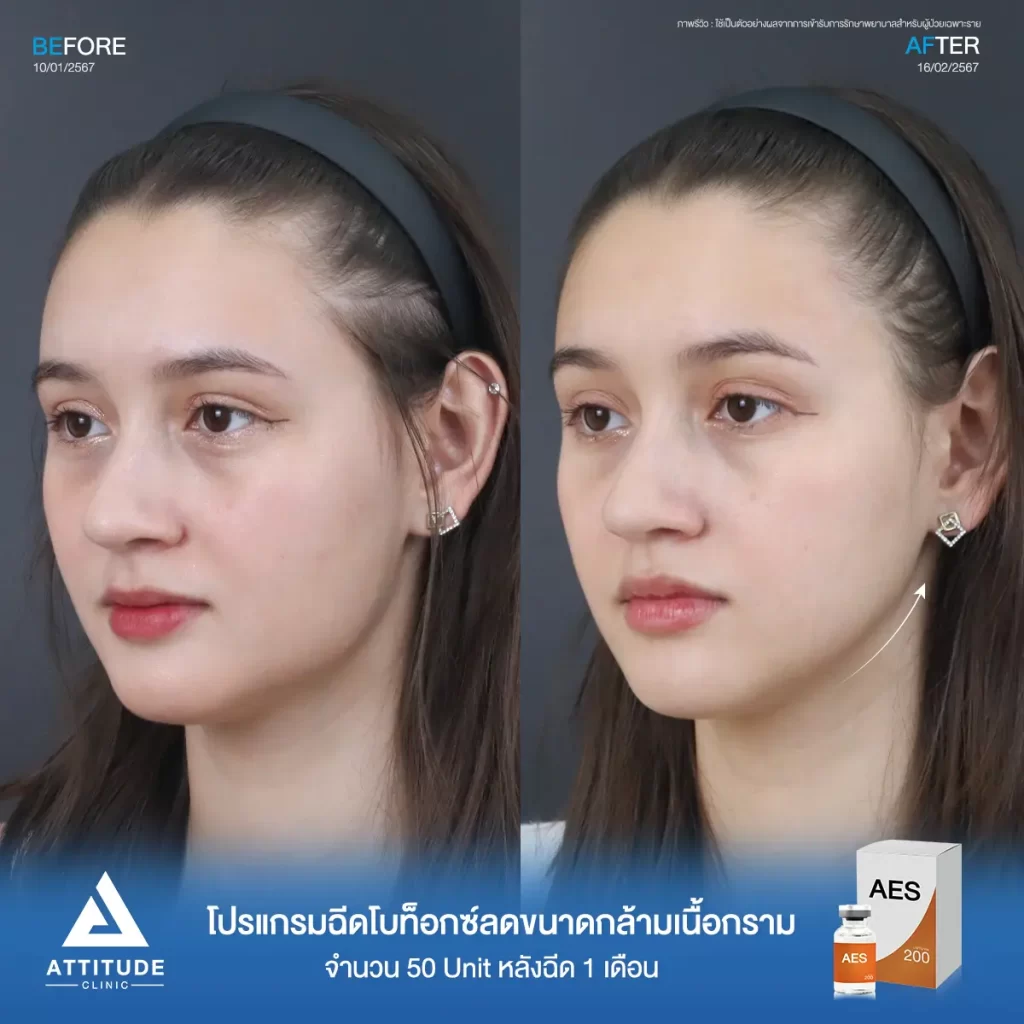 รีวิวโปรแกรมฉีดโบท็อกซ์ลดขนาดกล้ามเนื้อกรามคุณชาแนล จำนวน 50 Unit ปรับรูปหน้าให้ดูเรียวสวย เพิ่มมิติ ได้สัดส่วนมากขึ้นกับคุณหมอที่ Attitude Clinic