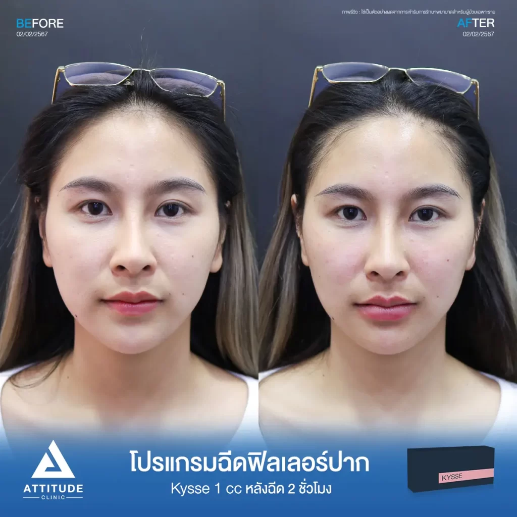 รีวิวโปรแกรมฉีดฟิลเลอร์ปากคุณนิ้ง รุ่น KYSSE จำนวน 1 cc หลังฉีด 2 ชั่วโมงของคุณนิ้ง เติมเต็มร่องริมฝีปาก ให้ปากอวบอิ่ม มีมิติได้ทรงสวย ปากชุ่มชื้น ดูสุขภาพดีที่ Attitude Clinic