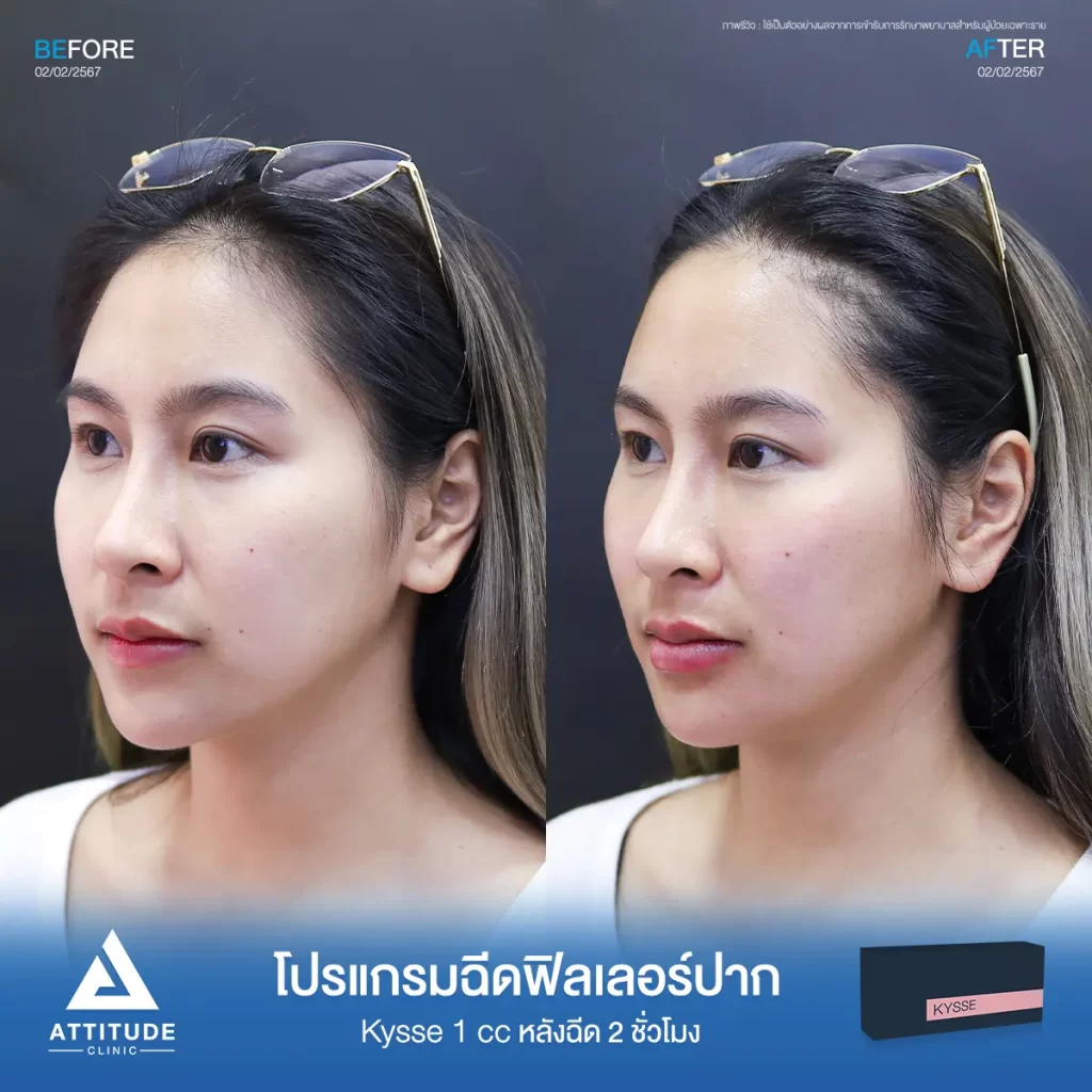 รีวิวโปรแกรมฉีดฟิลเลอร์ปากคุณนิ้ง รุ่น KYSSE จำนวน 1 cc หลังฉีด 2 ชั่วโมงของคุณนิ้ง เติมเต็มร่องริมฝีปาก ให้ปากอวบอิ่ม มีมิติได้ทรงสวย ปากชุ่มชื้น ดูสุขภาพดีที่ Attitude Clinic