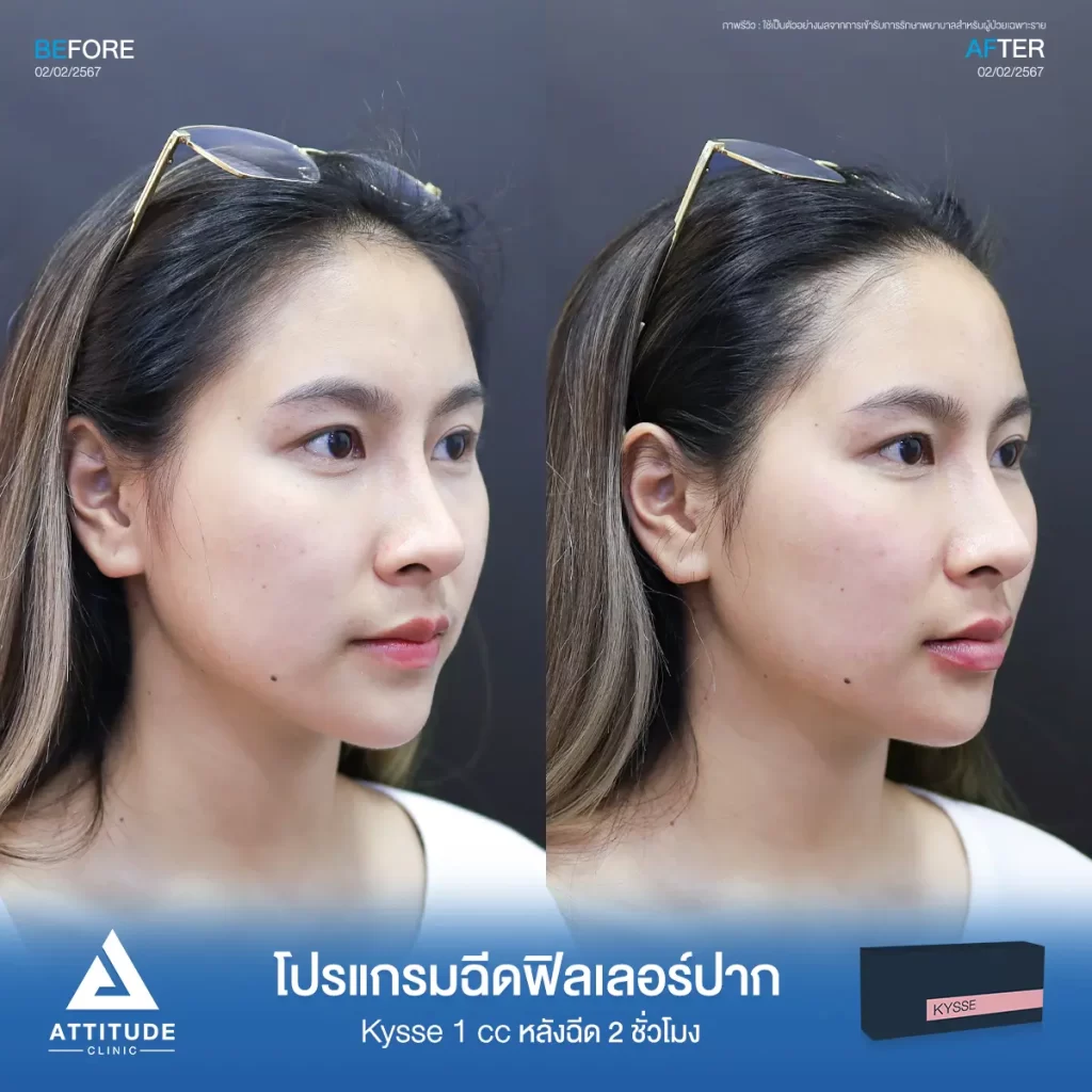 รีวิวโปรแกรมฉีดฟิลเลอร์ปากคุณนิ้ง รุ่น KYSSE จำนวน 1 cc หลังฉีด 2 ชั่วโมงของคุณนิ้ง เติมเต็มร่องริมฝีปาก ให้ปากอวบอิ่ม มีมิติได้ทรงสวย ปากชุ่มชื้น ดูสุขภาพดีที่ Attitude Clinic