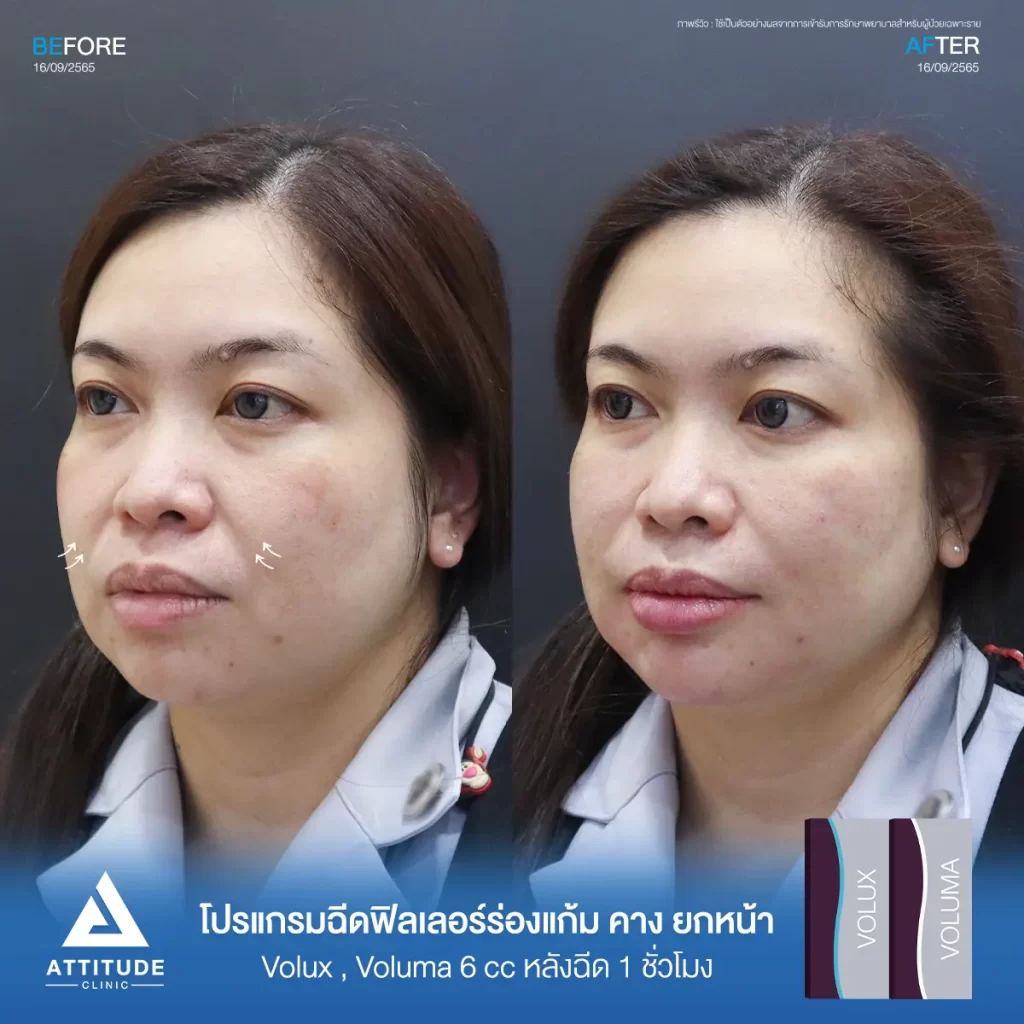 รีวิวโปรแกรมฉีดฟิลเลอร์ร่องแก้ม คาง ยกหน้าคุณนกยูงรุ่น Volux และ Voluma จำนวน 6 cc หลังฉีด 1 ชั่วโมง เติมร่องแก้มให้อิ่มฟู แก้หน้าโทรมให้ดูสดใส ปรับรูปหน้า ปรับคางเรียวสวย เพิ่มมิติให้ใบหน้าที่ Attitude Clinic