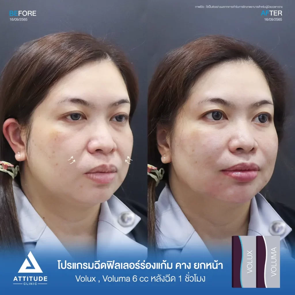 รีวิวโปรแกรมฉีดฟิลเลอร์ร่องแก้ม คาง ยกหน้าคุณนกยูงรุ่น Volux และ Voluma จำนวน 6 cc หลังฉีด 1 ชั่วโมง เติมร่องแก้มให้อิ่มฟู แก้หน้าโทรมให้ดูสดใส ปรับรูปหน้า ปรับคางเรียวสวย เพิ่มมิติให้ใบหน้าที่ Attitude Clinic