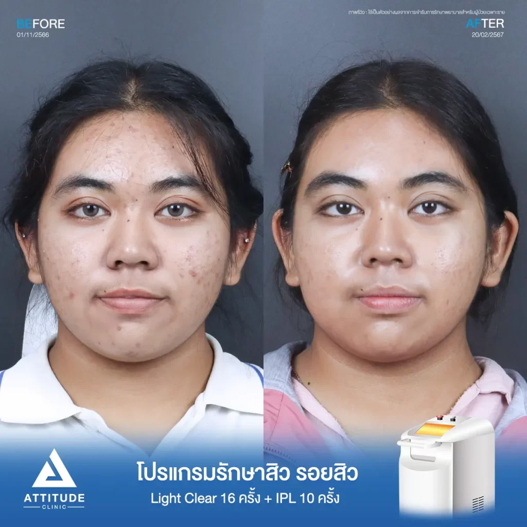 รีวิวรักษาสิวน้องปิงปิง ด้วยการฉายแสง Light Clear 7 ขั้นตอน จำนวน 16 ครั้ง และทำ IPL หน้าใส ลดรอยสิว จำนวน 10 ครั้ง รักษาสิวอุดตัน สิวผดเม็ดเล็กๆ และรอยสิวทั่วใบหน้าที่ Attitude Clinic