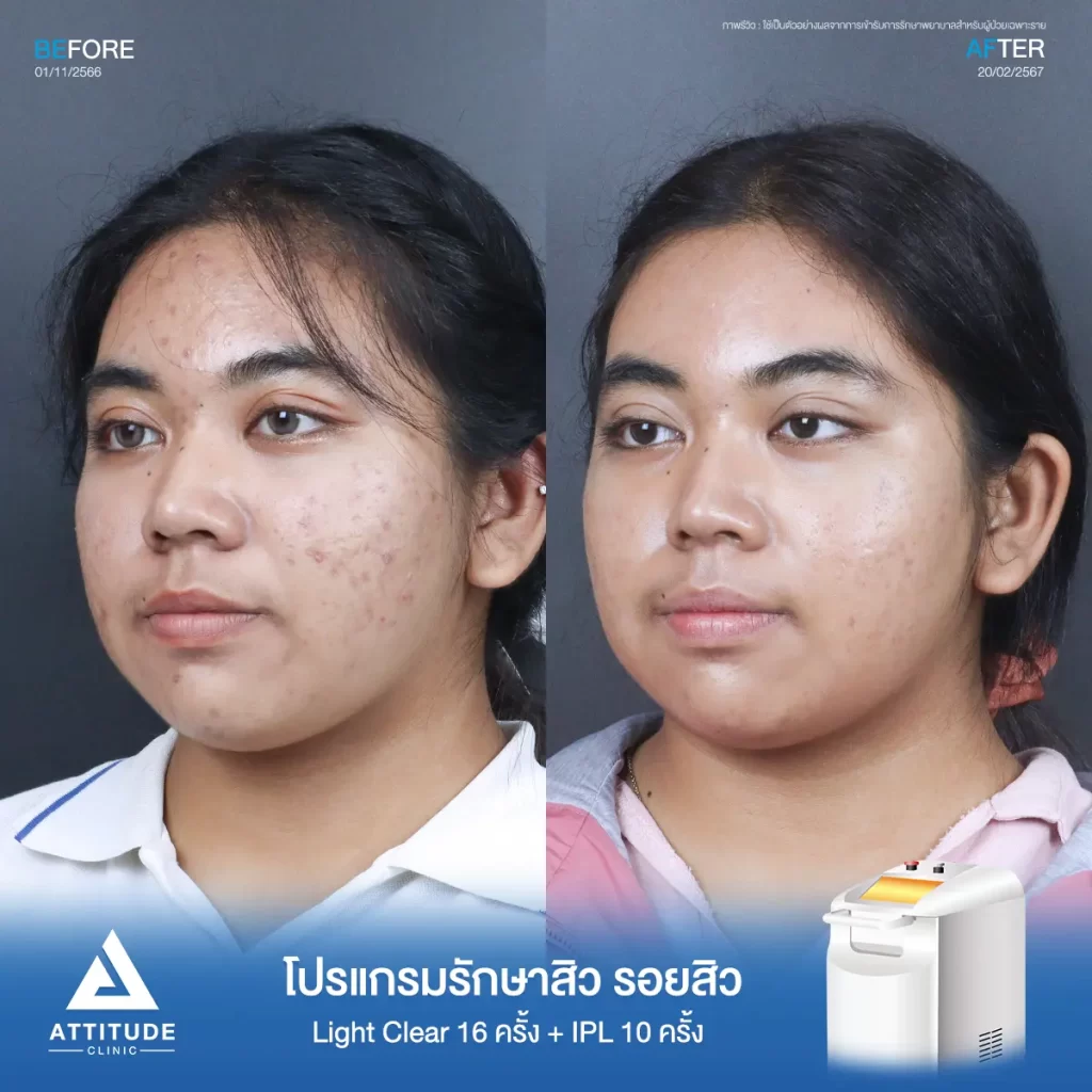 รีวิวรักษาสิวน้องปิงปิง ด้วยการฉายแสง Light Clear 7 ขั้นตอน จำนวน 16 ครั้ง และทำ IPL หน้าใส ลดรอยสิว จำนวน 10 ครั้ง รักษาสิวอุดตัน สิวผดเม็ดเล็กๆ และรอยสิวทั่วใบหน้าที่ Attitude Clinic