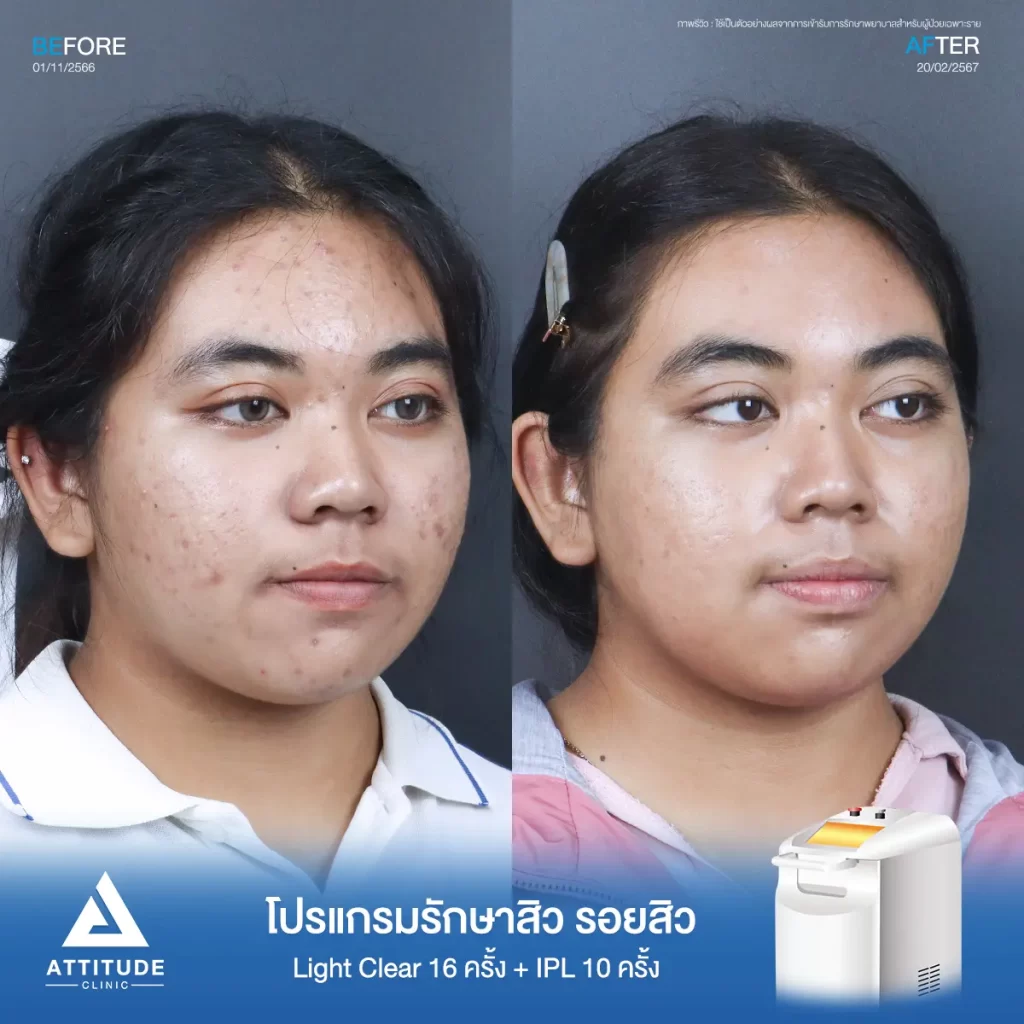 รีวิวรักษาสิวน้องปิงปิง ด้วยการฉายแสง Light Clear 7 ขั้นตอน จำนวน 16 ครั้ง และทำ IPL หน้าใส ลดรอยสิว จำนวน 10 ครั้ง รักษาสิวอุดตัน สิวผดเม็ดเล็กๆ และรอยสิวทั่วใบหน้าที่ Attitude Clinic