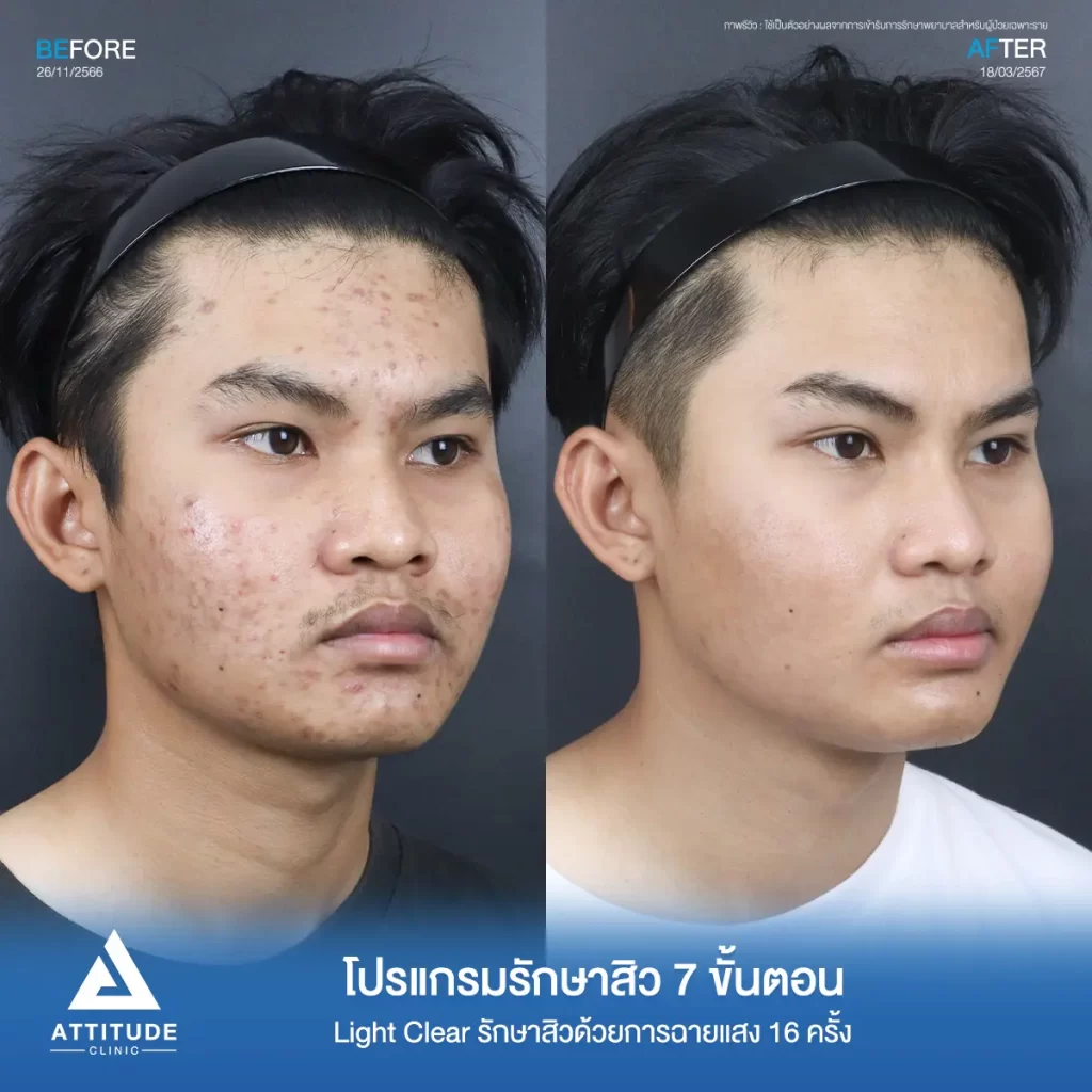 รีวิวรักษาสิวน้องบอส ด้วยการฉายแสง Light Clear 7 ขั้นตอน จำนวน 16 ครั้ง รักษาสิวอักเสบ สิวอุดตัน และรอยสิวทั่วใบหน้าที่ Attitude Clinic