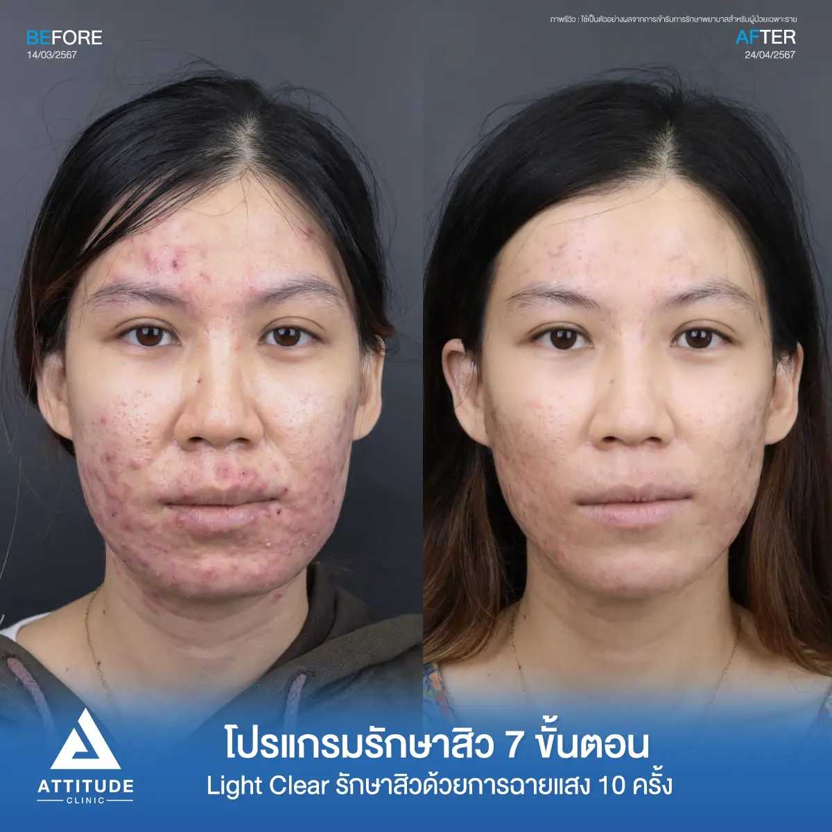 รีวิวรักษาสิวคุณเจนจิรา ด้วยการฉายแสง Light Clear 7 ขั้นตอน จำนวน 10 ครั้ง รักษาสิวอักเสบ สิวอุดตัน รอยแดงทั่วใบหน้าลามไปถึงช่วงลำคอที่ Attitude Clinic