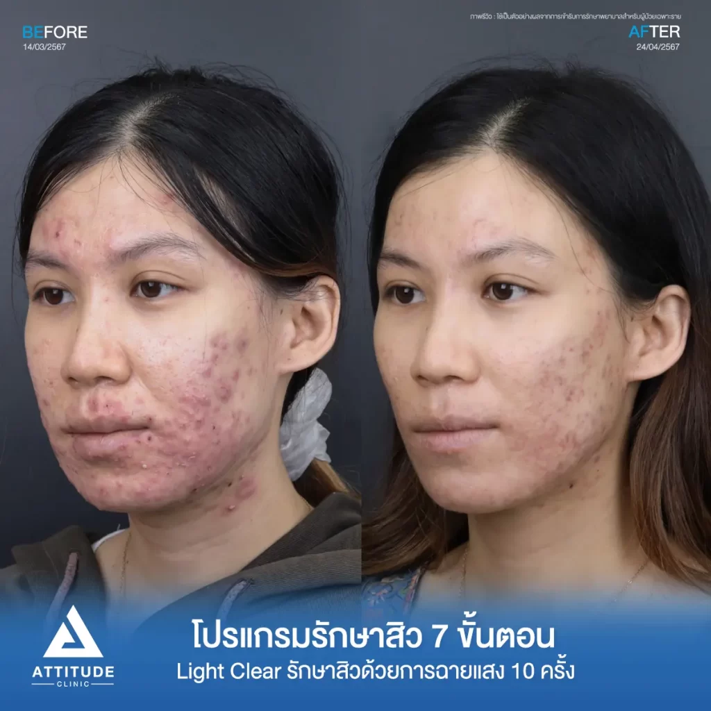 รีวิวรักษาสิวคุณเจนจิรา ด้วยการฉายแสง Light Clear 7 ขั้นตอน จำนวน 10 ครั้ง รักษาสิวอักเสบ สิวอุดตัน รอยแดงทั่วใบหน้าลามไปถึงช่วงลำคอที่ Attitude Clinic