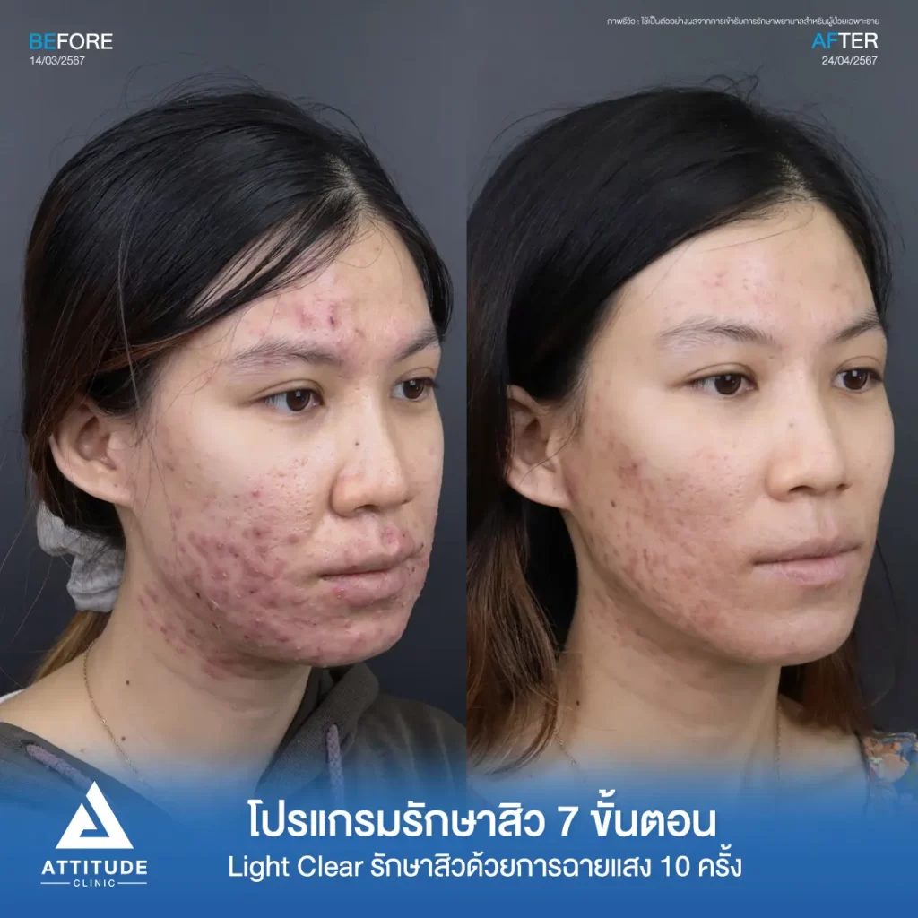 รีวิวรักษาสิวคุณเจนจิรา ด้วยการฉายแสง Light Clear 7 ขั้นตอน จำนวน 10 ครั้ง รักษาสิวอักเสบ สิวอุดตัน รอยแดงทั่วใบหน้าลามไปถึงช่วงลำคอที่ Attitude Clinic