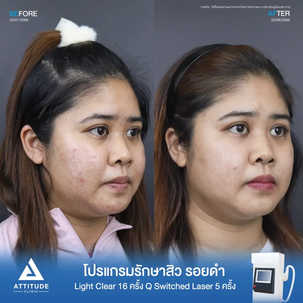 รีวิวรักษาสิวคุณจุฑาทิพย์ ด้วยการฉายแสง Light Clear 7 ขั้นตอน จำนวน 16 ครั้ง ทำ Q Switched Laser ลดรอยสิว จำนวน 5 ครั้ง รักษาสิวอุดตัน สิวผดเม็ดเล็กๆ รอยสิวดำจากสิวทั่วใบหน้าที่ Attitude Clinic