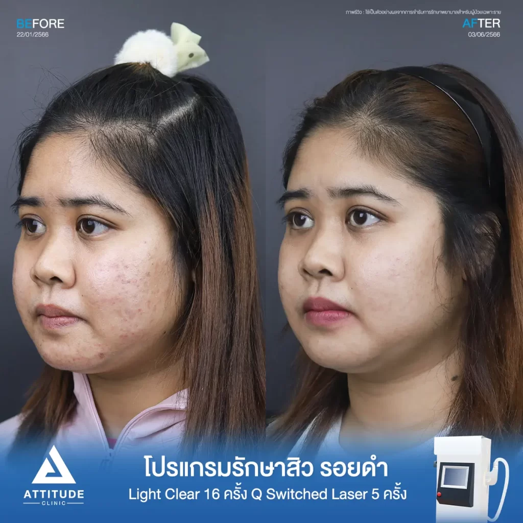 รีวิวรักษาสิวคุณจุฑาทิพย์ ด้วยการฉายแสง Light Clear 7 ขั้นตอน จำนวน 16 ครั้ง ทำ Q Switched Laser ลดรอยสิว จำนวน 5 ครั้ง รักษาสิวอุดตัน สิวผดเม็ดเล็กๆ รอยสิวดำจากสิวทั่วใบหน้าที่ Attitude Clinic