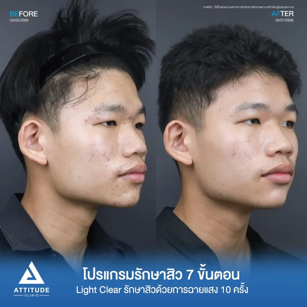 รีวิวรักษาสิวน้องณัฐปคัลภ์ ด้วยการฉายแสง Light Clear 7 ขั้นตอน จำนวน 10 ครั้ง รักษาสิวฮอร์โมน สิวอักเสบหัวหนอง สิวอุดตัน และรอยแดงทั่วใบหน้าที่ Attitude Clinic