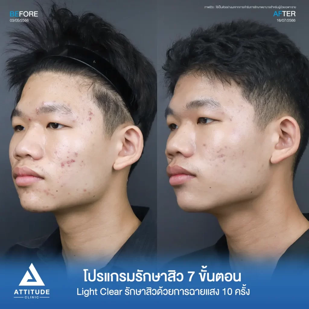 รีวิวรักษาสิวน้องณัฐปคัลภ์ ด้วยการฉายแสง Light Clear 7 ขั้นตอน จำนวน 10 ครั้ง รักษาสิวฮอร์โมน สิวอักเสบหัวหนอง สิวอุดตัน และรอยแดงทั่วใบหน้าที่ Attitude Clinic