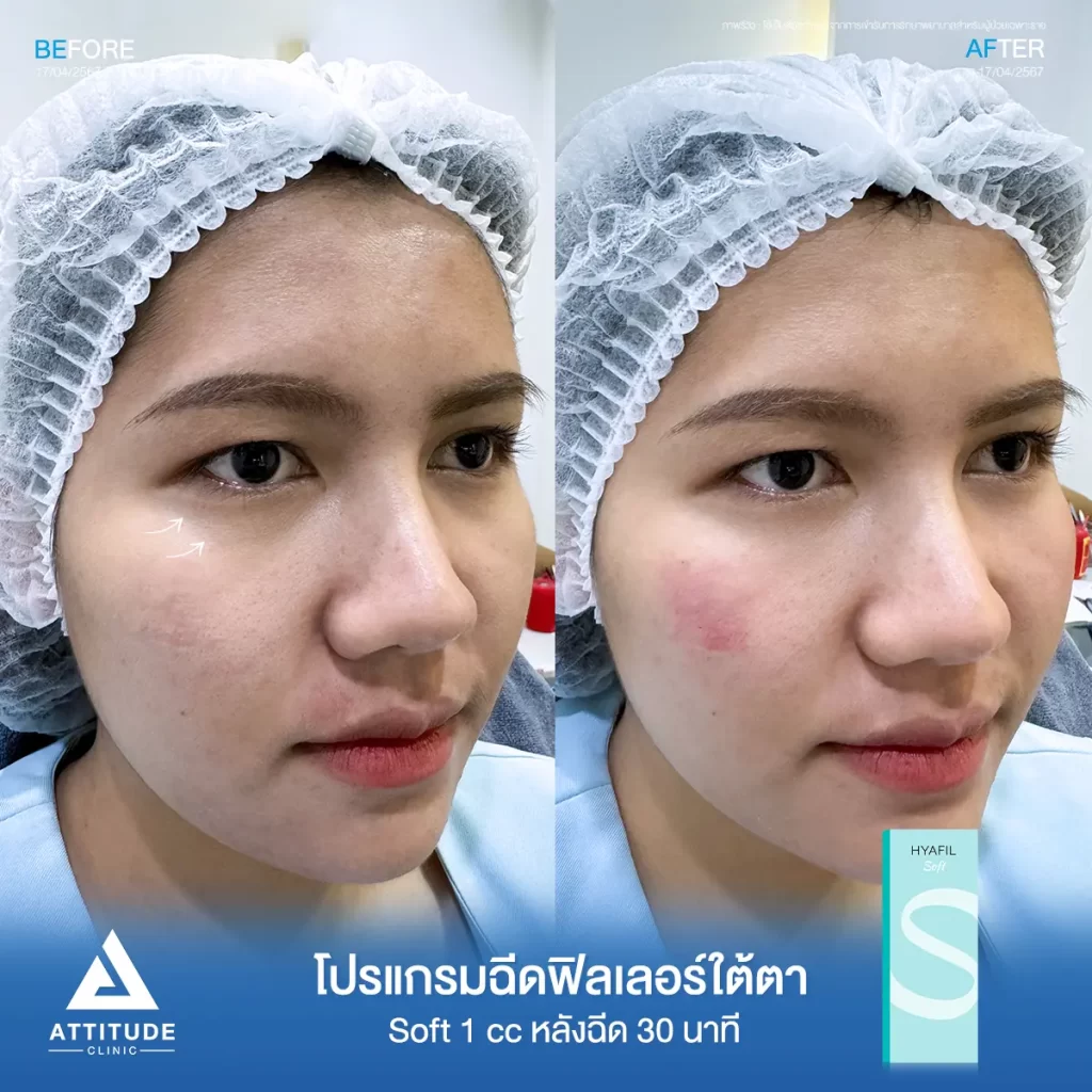 รีวิวโปรแกรมฉีดฟิลเลอร์ใต้ตาคุณเดียร์ รุ่น S จำนวน 1 cc หลังฉีด 30 นาที แก้ปัญหาใต้ตาหมองคล้ำ เติมเต็มร่องลึกใต้ตาให้อิ่มฟูกลับมาดูสดใส ไม่โทรม ลดริ้วรอยเล็กๆ ดูเป็นธรรมชาติที่ Attitude Clinic