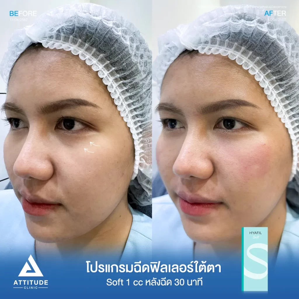 รีวิวโปรแกรมฉีดฟิลเลอร์ใต้ตาคุณเดียร์ รุ่น S จำนวน 1 cc หลังฉีด 30 นาที แก้ปัญหาใต้ตาหมองคล้ำ เติมเต็มร่องลึกใต้ตาให้อิ่มฟูกลับมาดูสดใส ไม่โทรม ลดริ้วรอยเล็กๆ ดูเป็นธรรมชาติที่ Attitude Clinic