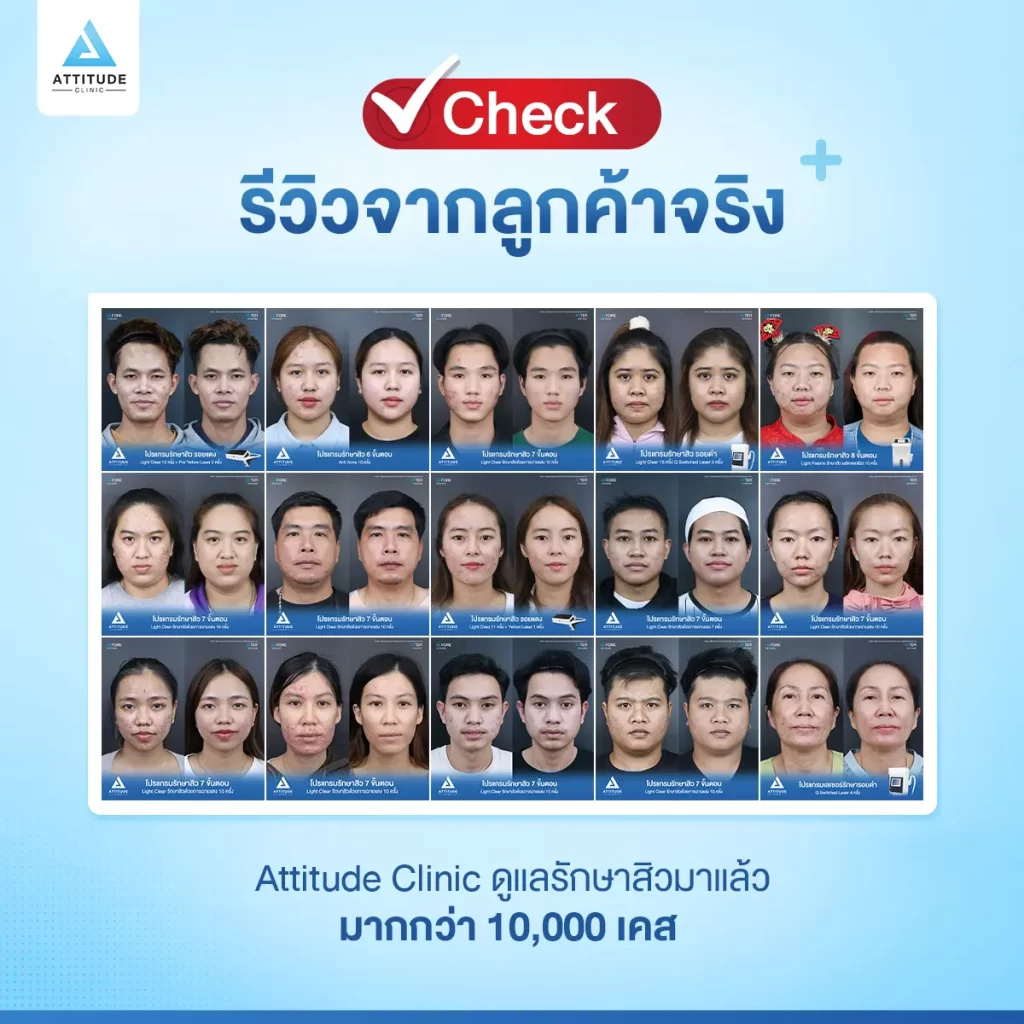 5 Checklist อยากสิวหายต้องเลือกยังไงก่อนตัดสินใจรักษา ?