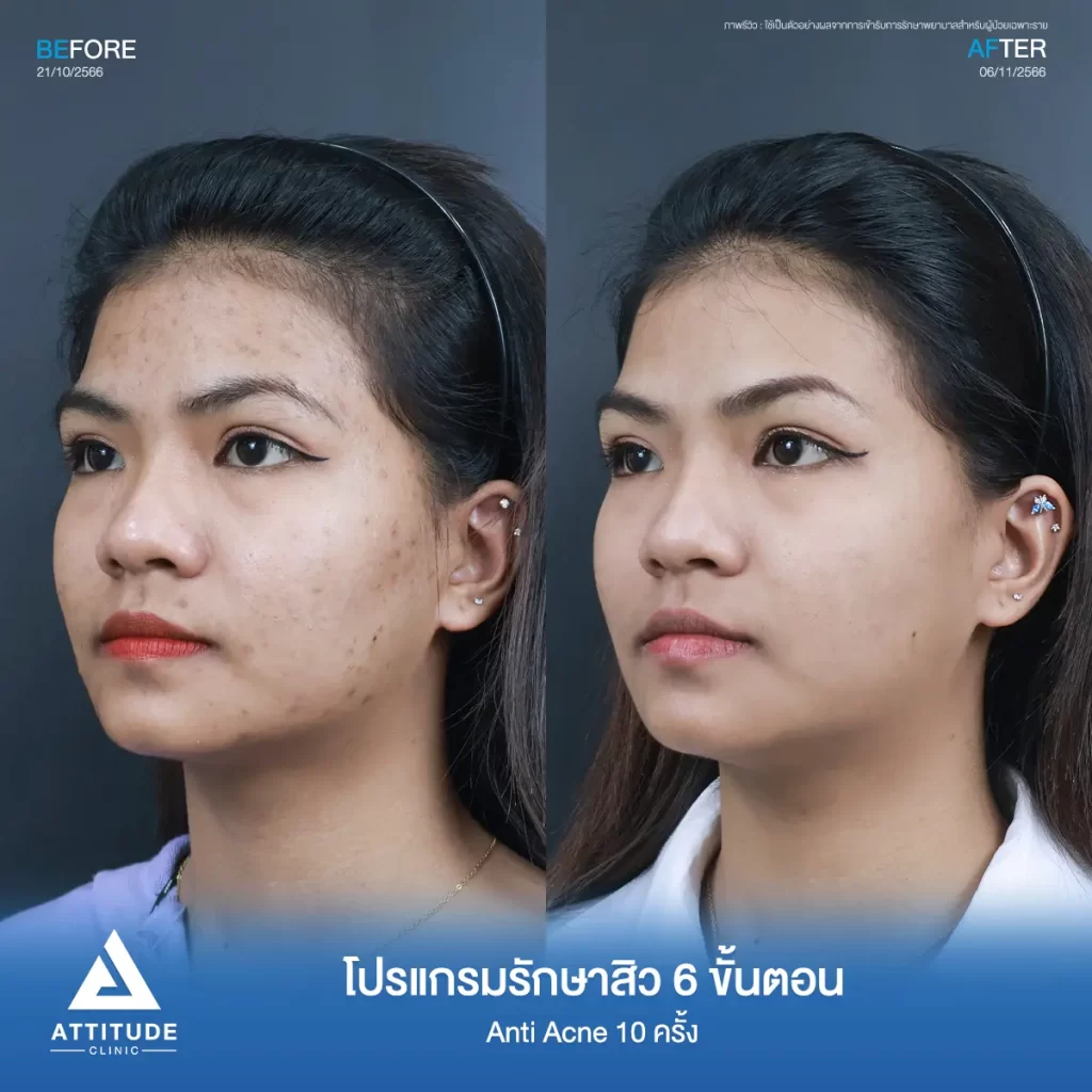 รีวิวรักษาสิวคุณกิ๊ฟ 6 ขั้นตอน โปรแกรม Anti Acne จำนวน 10 ครั้ง รักษาสิวอุดตัน สิวผดเม็ดเล็กๆ รอยสิวทั่วใบหน้า โดยเฉพาะบริเวณกรอบหน้าที่ Attitude Clinic