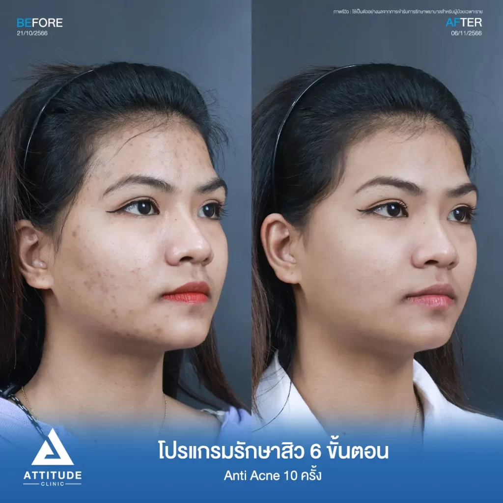 รีวิวรักษาสิวคุณกิ๊ฟ 6 ขั้นตอน โปรแกรม Anti Acne จำนวน 10 ครั้ง รักษาสิวอุดตัน สิวผดเม็ดเล็กๆ รอยสิวทั่วใบหน้า โดยเฉพาะบริเวณกรอบหน้าที่ Attitude Clinic