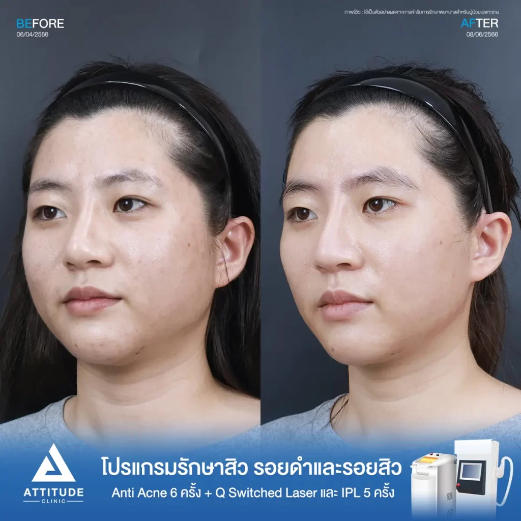 รีวิวรักษาสิวคุณขวัญ ด้วยการฉายแสง Light Clear 7 ขั้นตอน จำนวน 6 ครั้ง ทำ IPL หน้าใส และ Q Switched Laser ลดรอยสิว จำนวน 5 ครั้ง รักษาสิวอุดตัน สิวผดเม็ดเล็กๆ รอยสิว และผิวหมองคล้ำทั่วใบหน้า โดยเฉพาะบริเวณคางที่ Attitude Clinic