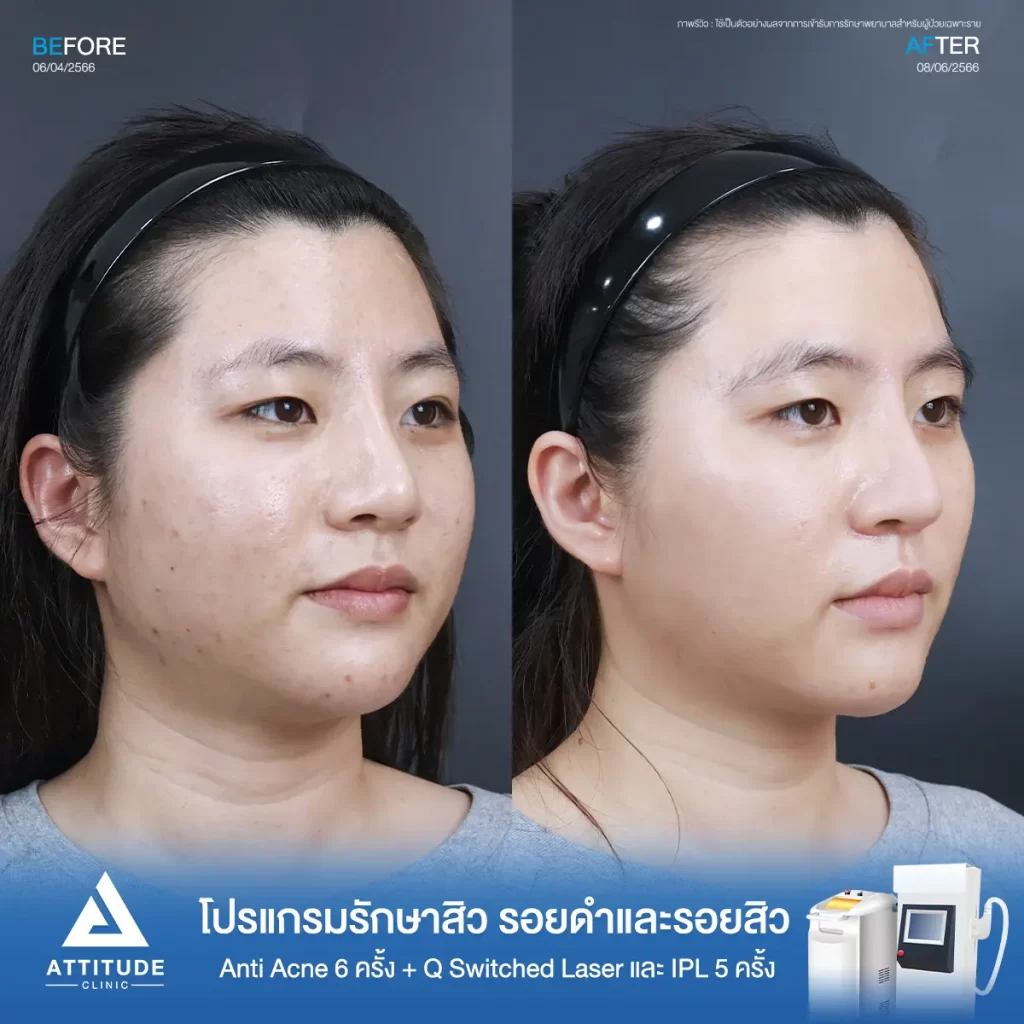 รีวิวรักษาสิวคุณขวัญ ด้วยการฉายแสง Light Clear 7 ขั้นตอน จำนวน 6 ครั้ง ทำ IPL หน้าใส และ Q Switched Laser ลดรอยสิว จำนวน 5 ครั้ง รักษาสิวอุดตัน สิวผดเม็ดเล็กๆ รอยสิว และผิวหมองคล้ำทั่วใบหน้า โดยเฉพาะบริเวณคางที่ Attitude Clinic