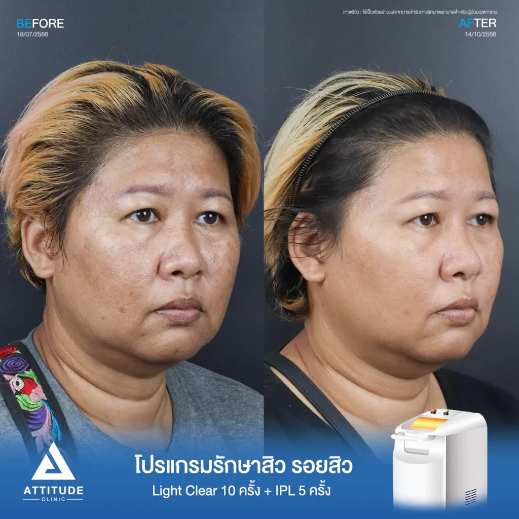 รีวิวรักษาสิวคุณปราง ด้วยการฉายแสง Light Clear 7 ขั้นตอน จำนวน 10 ครั้ง และทำ IPL หน้าใส ลดรอยสิว จำนวน 5 ครั้ง รักษาสิวอุดตัน สิวผดเม็ดเล็กๆ รอยสิว และลดความหมองคล้ำทั่วใบหน้าที่ Attitude Clinic