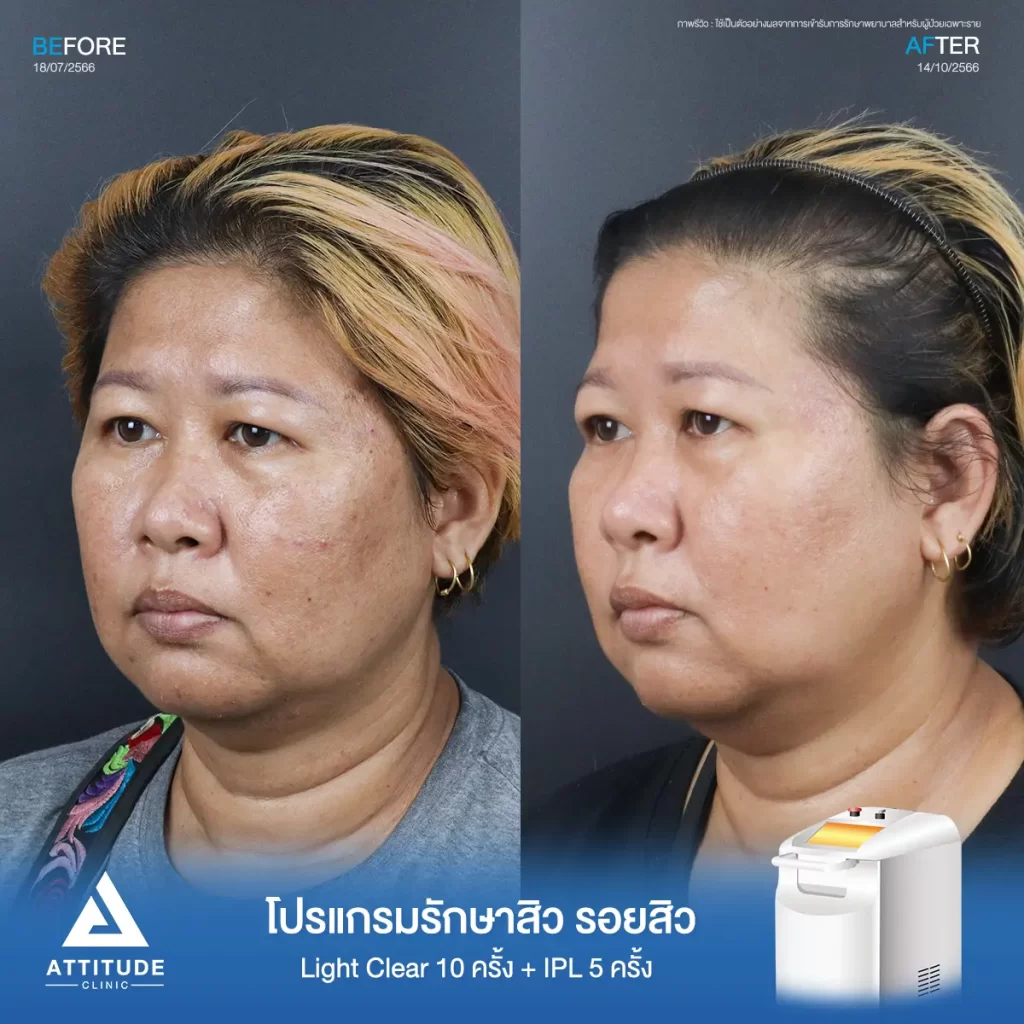 รีวิวรักษาสิวคุณปราง ด้วยการฉายแสง Light Clear 7 ขั้นตอน จำนวน 10 ครั้ง และทำ IPL หน้าใส ลดรอยสิว จำนวน 5 ครั้ง รักษาสิวอุดตัน สิวผดเม็ดเล็กๆ รอยสิว และลดความหมองคล้ำทั่วใบหน้าที่ Attitude Clinic