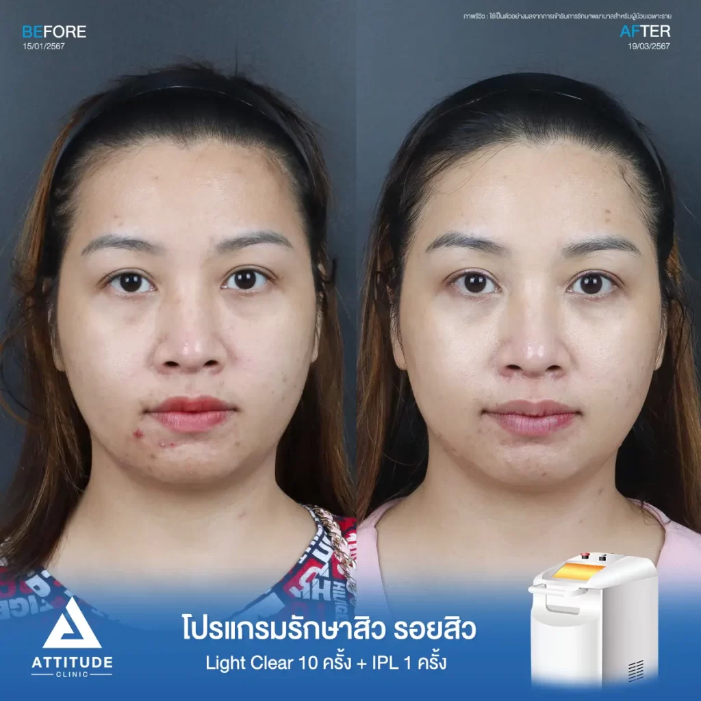 รีวิวรักษาสิวคุณอ้อ ด้วยการฉายแสง Light Clear 7 ขั้นตอน จำนวน 10 ครั้ง และทำ IPL หน้าใส ลดรอยสิว จำนวน 1 ครั้ง รักษาสิวอักเสบ สิวอุดตัน สิวผดเม็ดเล็กๆ รอยสิวทั่วใบหน้า โดยเฉพาะบริเวณคางที่ Attitude Clinic