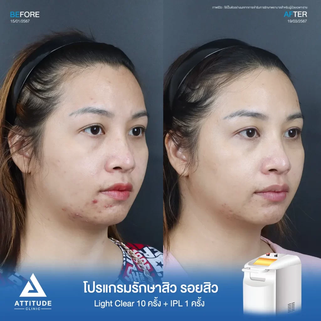 รีวิวรักษาสิวคุณอ้อ ด้วยการฉายแสง Light Clear 7 ขั้นตอน จำนวน 10 ครั้ง และทำ IPL หน้าใส ลดรอยสิว จำนวน 1 ครั้ง รักษาสิวอักเสบ สิวอุดตัน สิวผดเม็ดเล็กๆ รอยสิวทั่วใบหน้า โดยเฉพาะบริเวณคางที่ Attitude Clinic