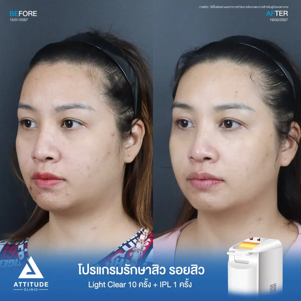 รีวิวรักษาสิวคุณอ้อ ด้วยการฉายแสง Light Clear 7 ขั้นตอน จำนวน 10 ครั้ง และทำ IPL หน้าใส ลดรอยสิว จำนวน 1 ครั้ง รักษาสิวอักเสบ สิวอุดตัน สิวผดเม็ดเล็กๆ รอยสิวทั่วใบหน้า โดยเฉพาะบริเวณคางที่ Attitude Clinic