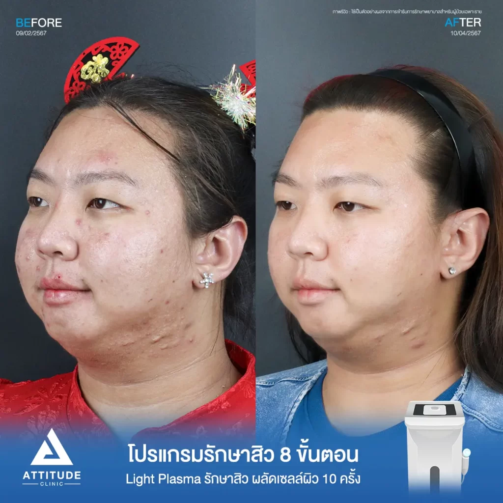 รีวิวรักษาสิวคุณแพ็คซี่ ด้วยการฉายแสง Light Plasma 8 ขั้นตอน จำนวน 1 ครั้ง รักษาสิวอักเสบ สิวอุดตัน สิวผดเม็ดเล็กๆ และรอยสิวทั่วใบหน้าจนถึงช่วงคอที่ Attitude Clinic