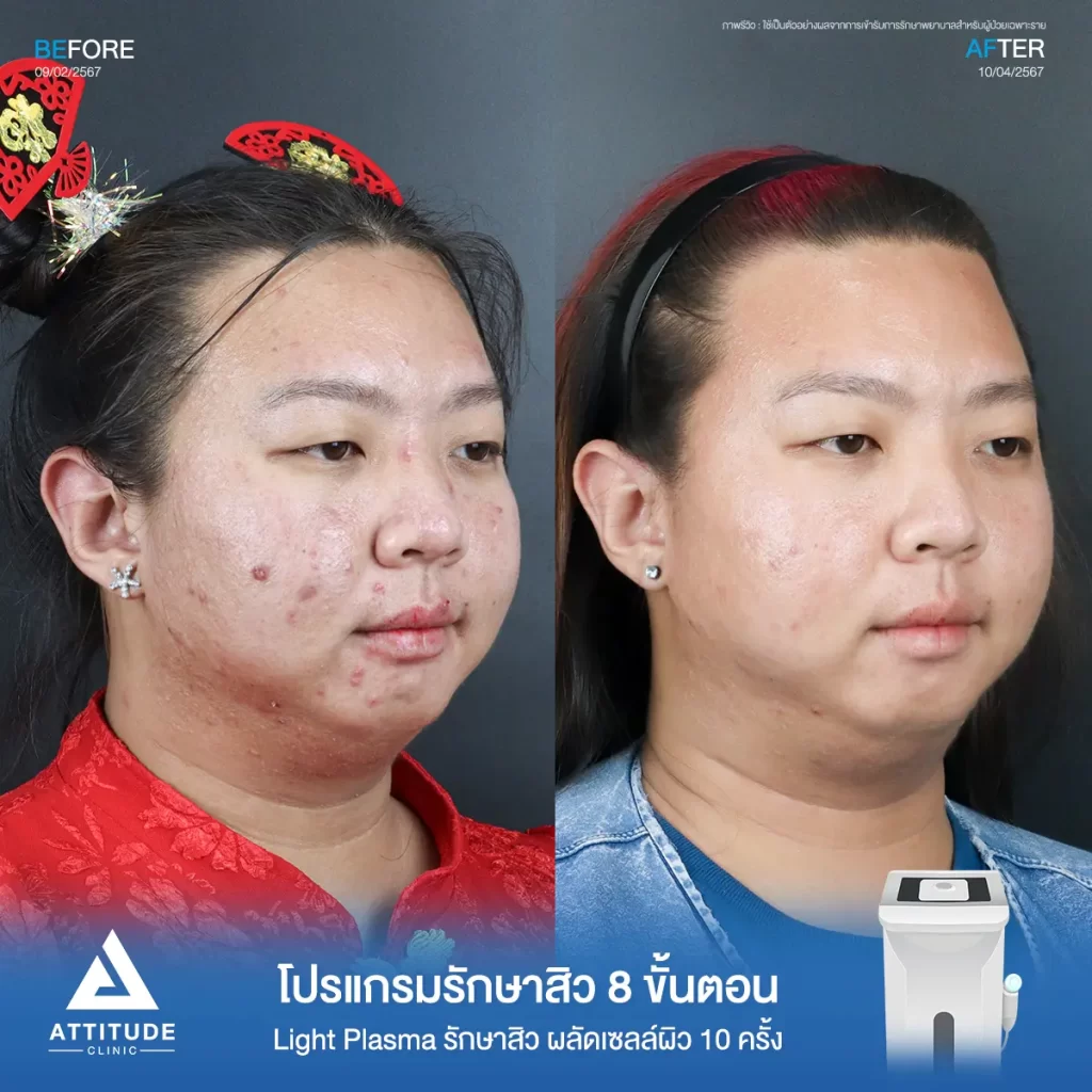 รีวิวรักษาสิวคุณแพ็คซี่ ด้วยการฉายแสง Light Plasma 8 ขั้นตอน จำนวน 1 ครั้ง รักษาสิวอักเสบ สิวอุดตัน สิวผดเม็ดเล็กๆ และรอยสิวทั่วใบหน้าจนถึงช่วงคอที่ Attitude Clinic