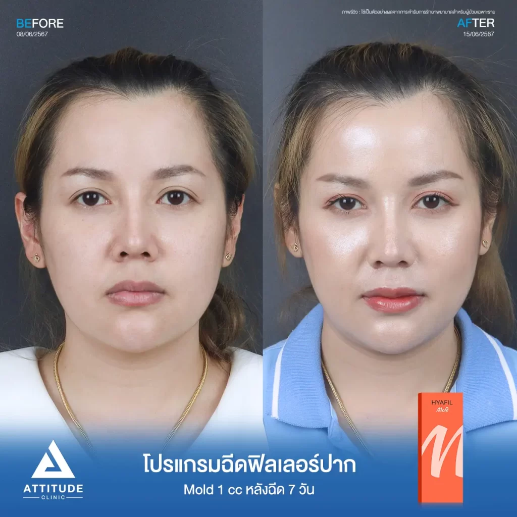 รีวิวโปรแกรมฉีดฟิลเลอร์ปากคุณมิกซ์ รุ่น M จำนวน 1 cc หลังฉีด 7 วัน เติมเต็มให้อวบอิ่ม เป็นทรงสวยตามที่ต้องการ มุมปากยก ได้รูป ริมฝีปากเรียบเนียน ดูเป็นธรรมชาติที่ Attitude Clinic